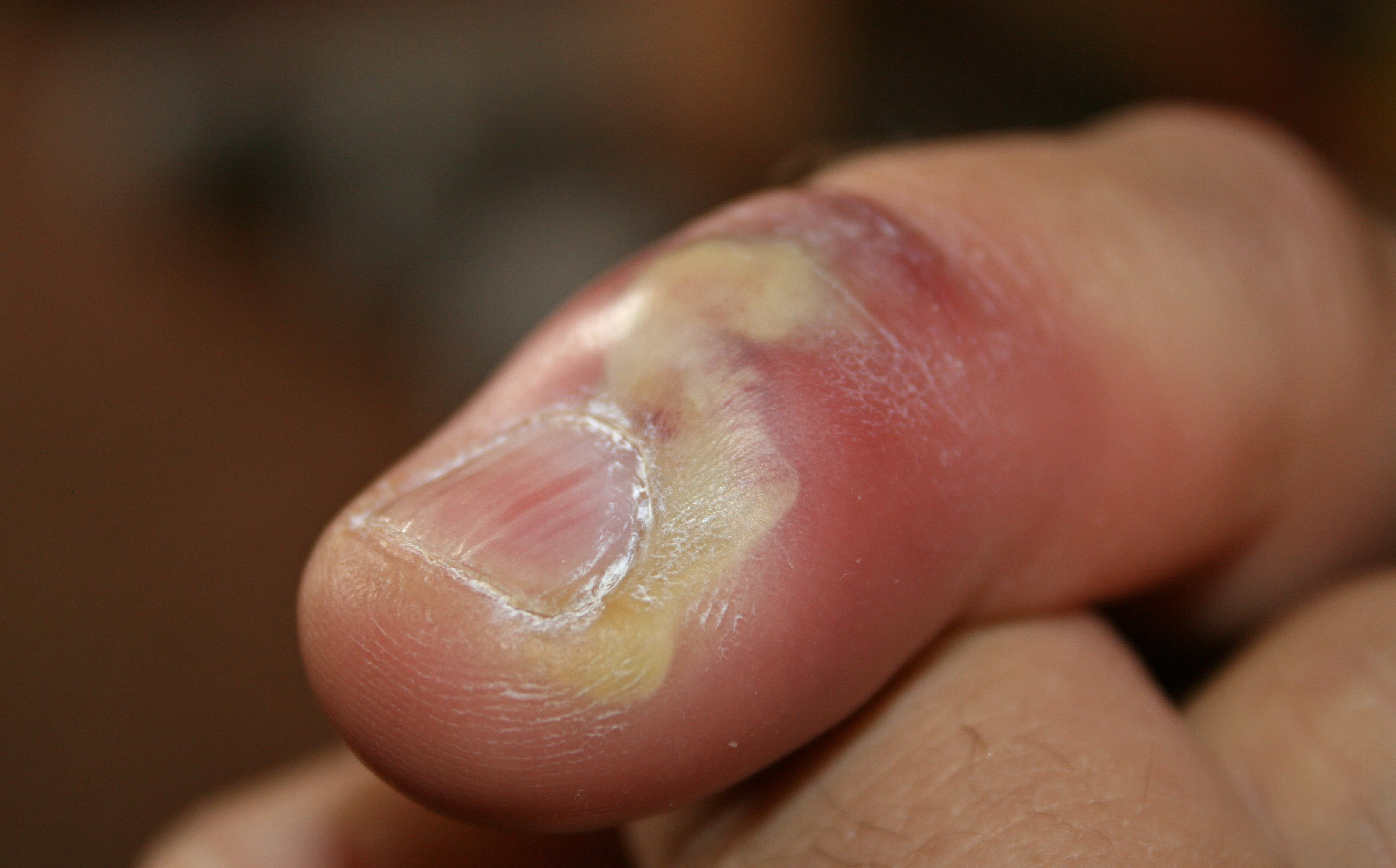Oblique close-up of a thumb with acute paronychia showing pus tracking around the proximal nail fold - the drainage decision pathway for a run-around abscess in management