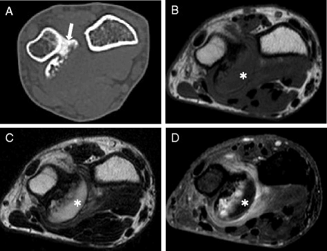 Paired CT and axial T1-weighted MRI images of a bony mass on the distal ulna.