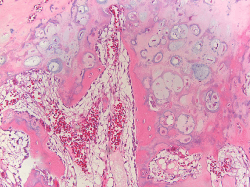 Photomicrograph showing a cartilage cap with columnar chondrocytes over bone.