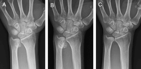 Series of anteroposterior wrist radiographs showing calcification then a bony prominence on the distal ulna.