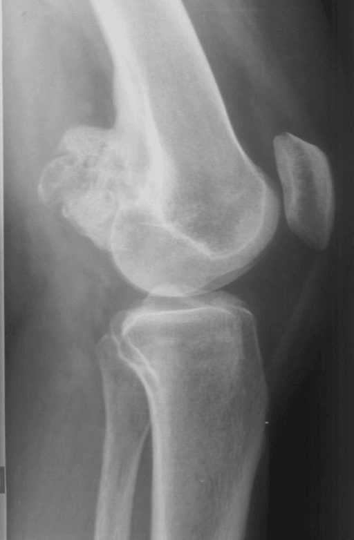 Lateral knee radiograph with a lobulated ossified mass on the posterior distal femur.