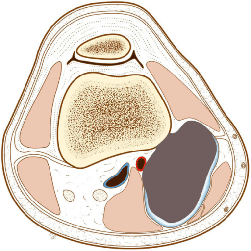 Radiograph of an early surface tumour with a nearly intact cortex beneath it.