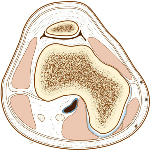 Illustration of an osteochondroma showing cortical and marrow continuity with the femur.