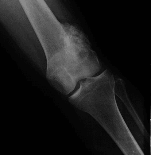 Anteroposterior radiograph of a limb showing an ossified lesion on the bone surface.