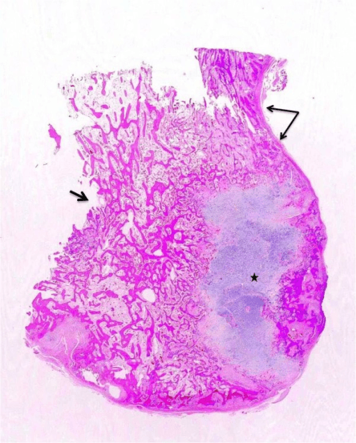 Cut gross specimen of a bony surface tumour with peripheral cartilage and trabecular bone.