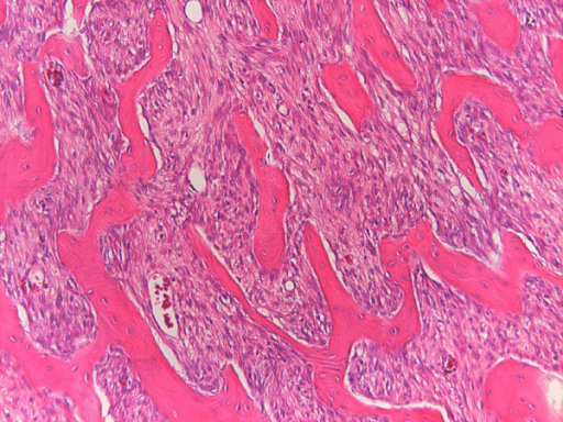 Photomicrograph of bland spindle cells between bony trabeculae.