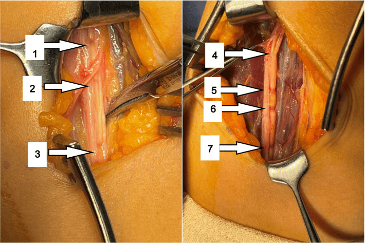 Operative photographs showing multiple hourglass constrictions along the anterior interosseous nerve before and after neurolysis