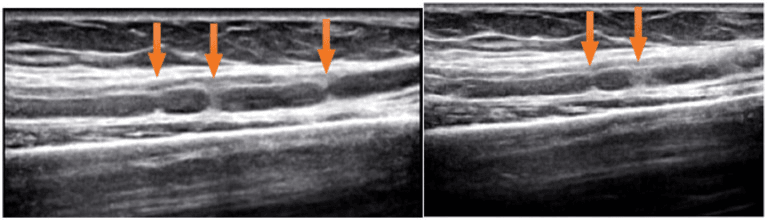 Longitudinal ultrasound showing multiple focal hourglass constrictions of the anterior interosseous nerve