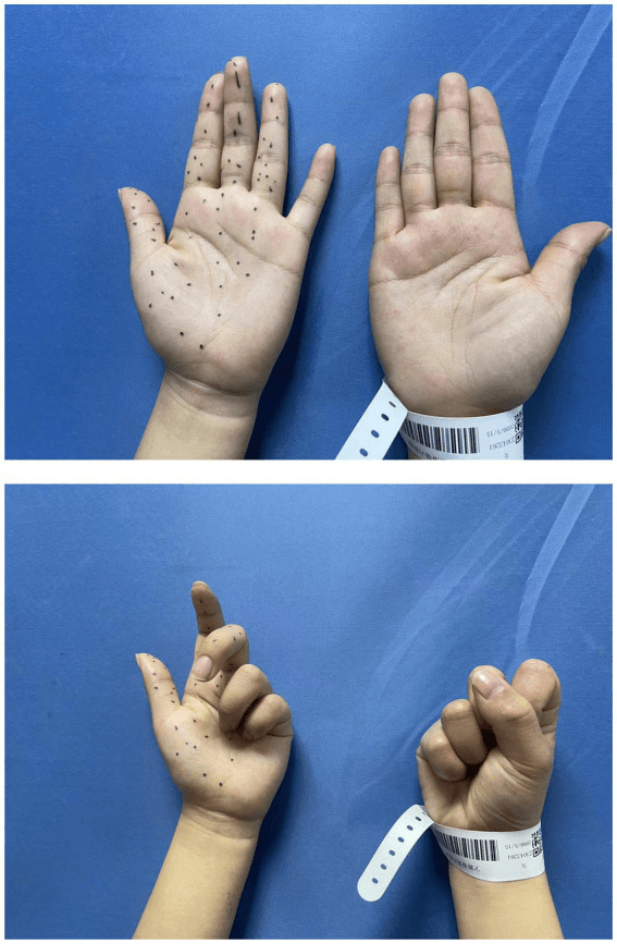 Bilateral hand examination demonstrating loss of thumb and index-finger flexion from anterior interosseous palsy