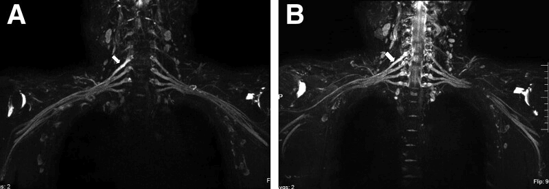 Serial coronal MR neurography showing thickening and high signal of the C5 root followed by partial improvement
