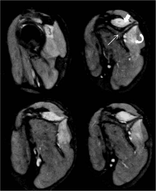 Axial shoulder MRI showing patchy high T2 signal from muscle denervation