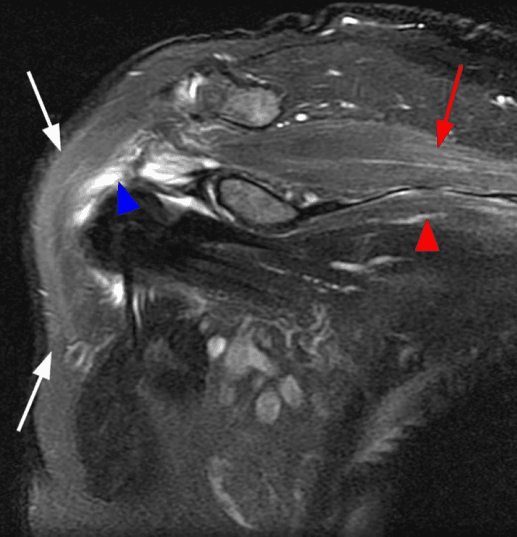 Fat-suppressed shoulder MRI showing multifocal oedema in supraspinatus and upper subscapularis