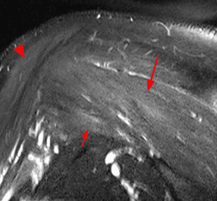 Shoulder MRI showing patchy denervation oedema in the infraspinatus deltoid and teres minor muscles