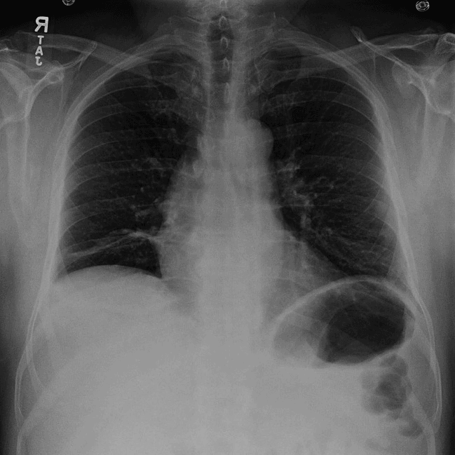 Chest radiograph showing elevation of the right hemidiaphragm in brachial plexitis