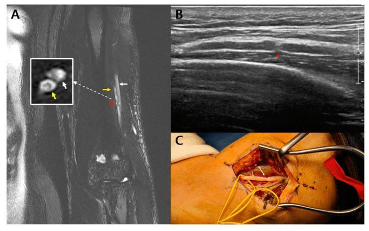 MR neurography ultrasound and operative images showing a focal posterior interosseous fascicular constriction