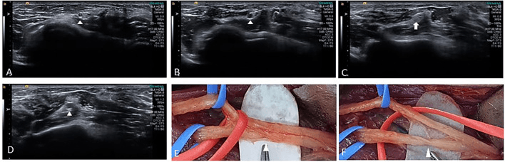 Sequential ultrasound and operative images showing swelling and constriction of the posterior interosseous fascicle within the radial nerve