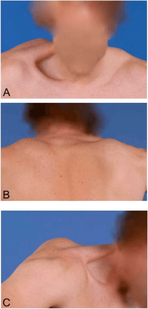 Clinical photograph anterior and posterior views showing shoulder girdle muscle wasting and asymmetry
