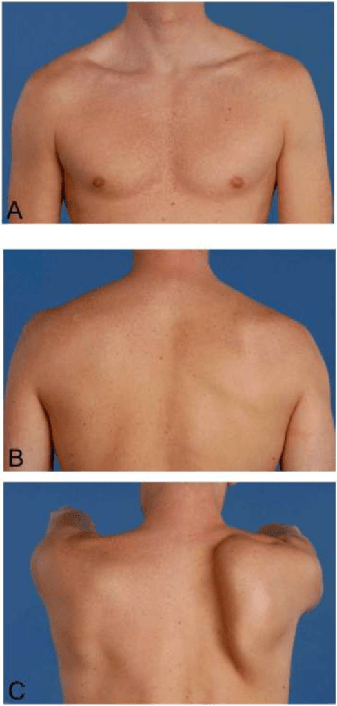 Clinical photograph posterior view showing medial scapular winging in neuralgic amyotrophy