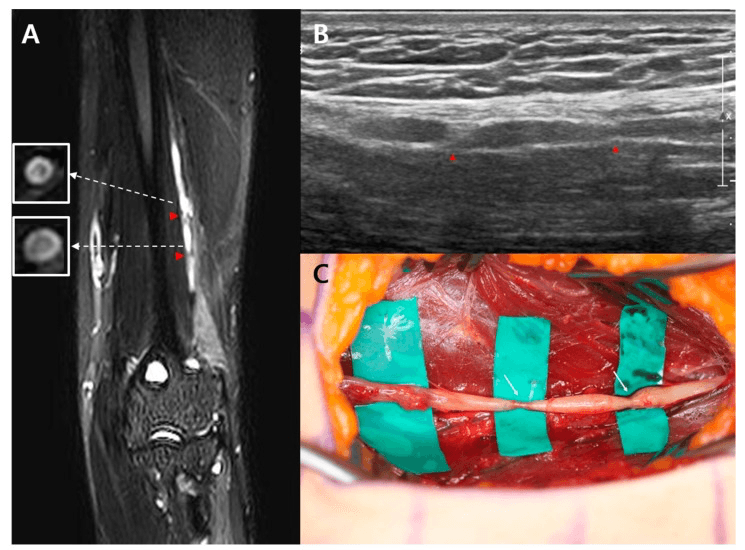MR neurography ultrasound and operative images showing two focal constrictions of the radial nerve