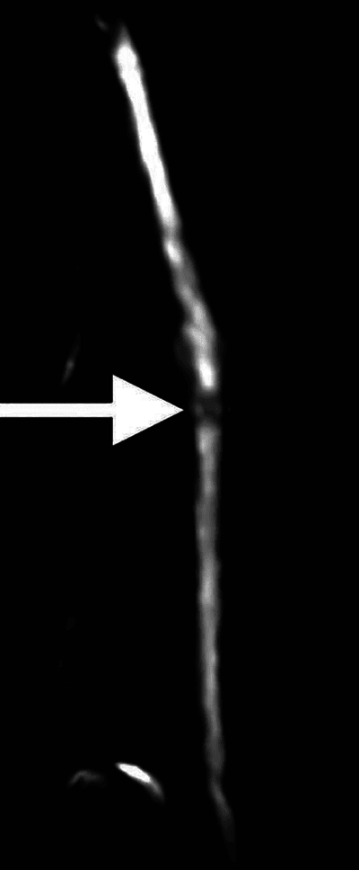 Three-dimensional STIR MR neurography showing diffuse radial-nerve thickening with a focal narrowing