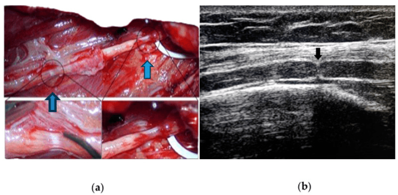 Intraoperative and ultrasound images showing two spontaneous hourglass constrictions of the radial nerve