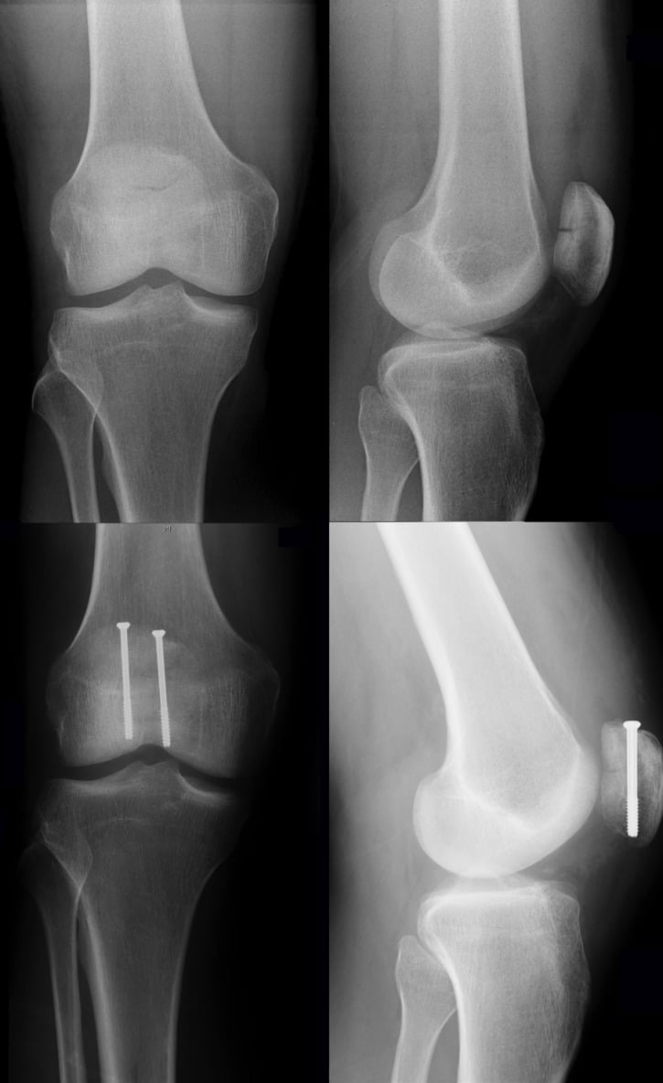 Preoperative and 3-month postoperative radiographs of a transverse patellar fracture treated by percutaneous screw fixation