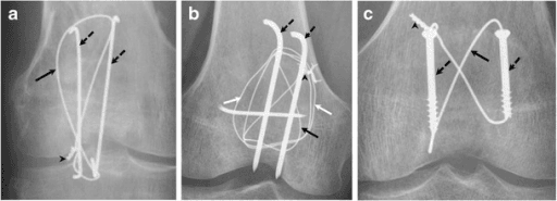 Frontal knee radiographs comparing tension band wiring, cerclage, and cannulated screw constructs