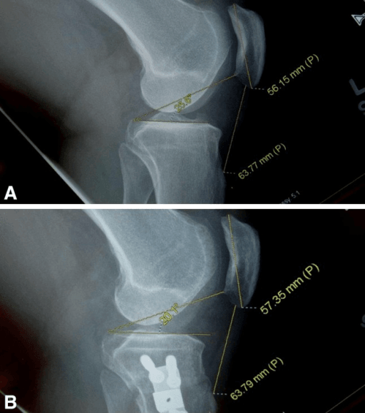 Lateral knee radiographs demonstrating Insall-Salvati index and plateau-patella angle measurements before and after surgery