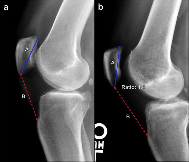 Lateral knee radiograph demonstrating Insall-Salvati index measurement