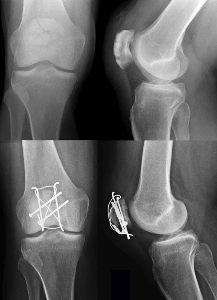 Preoperative and 3-month postoperative radiographs of a comminuted patella fracture
