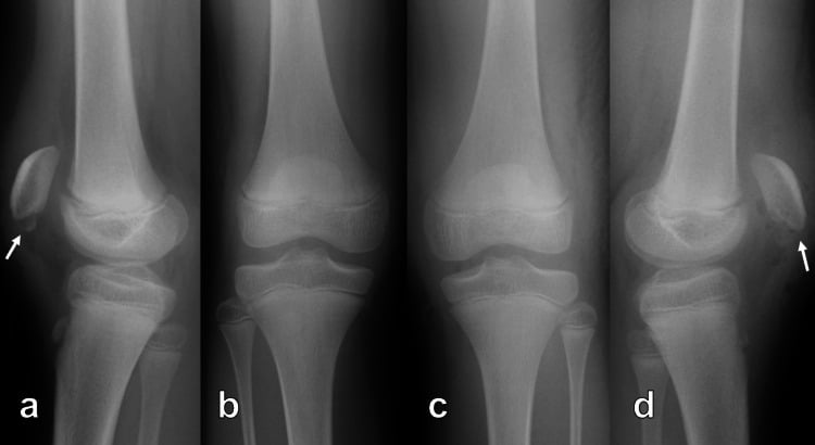 Postoperative knee radiograph showing inferior pole patellar fracture reduction