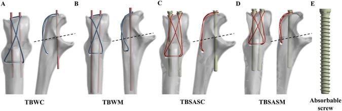 Schematic diagram of tension band wiring constructs for patellar fracture fixation