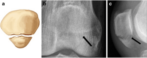 Drawing and radiographs of an inferior pole patellar avulsion fracture