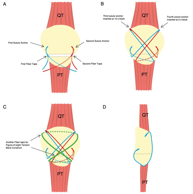 Schematic diagram of double-row suture anchor technique for inferior pole patella fracture repair