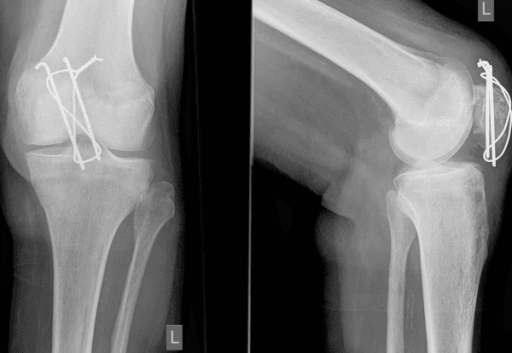 Anteroposterior and lateral knee radiographs showing tension band wiring fixation of a patella fracture