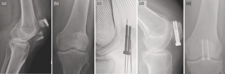 Radiographs demonstrating cannulated screw fixation of a transverse patellar fracture