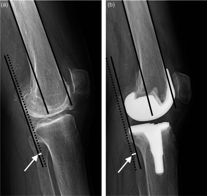 Lateral knee radiographs before and after total knee arthroplasty with femoral and tibial reference lines used to assess sagittal alignment and patellar height.