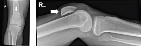 AP and lateral radiographs of a right knee showing a high-riding patella (patella alta) from patellar tendon rupture