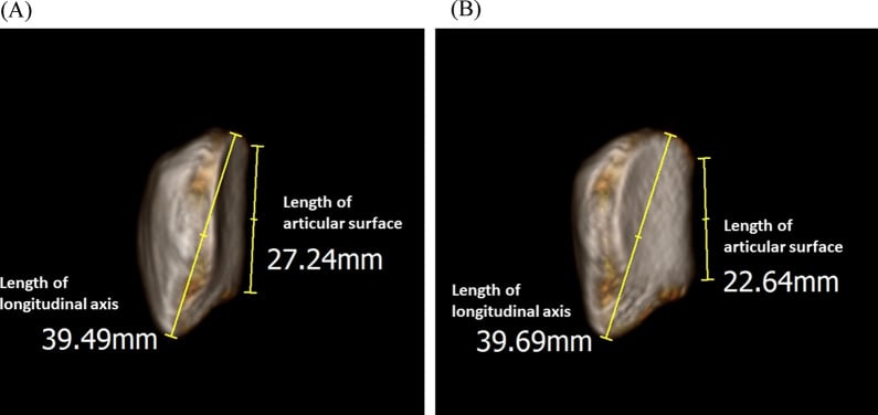 Three-dimensional patellar models showing the length of the articular surface measured against the longitudinal axis with and without patellar tilt