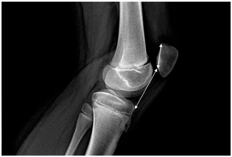 Lateral radiograph illustrating the Caton-Deschamps index as the ratio between the patellar articular surface length and the distance from the anterior tibial plateau to the inferior patellar articular surface