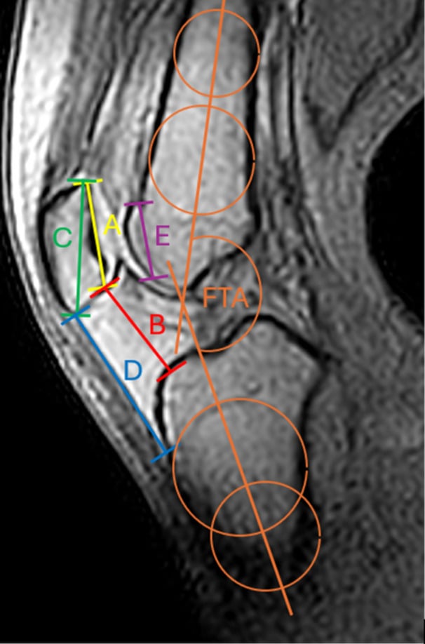 Dynamic sagittal MRI of the knee with the femorotibial flexion angle measured and patellar height segments marked
