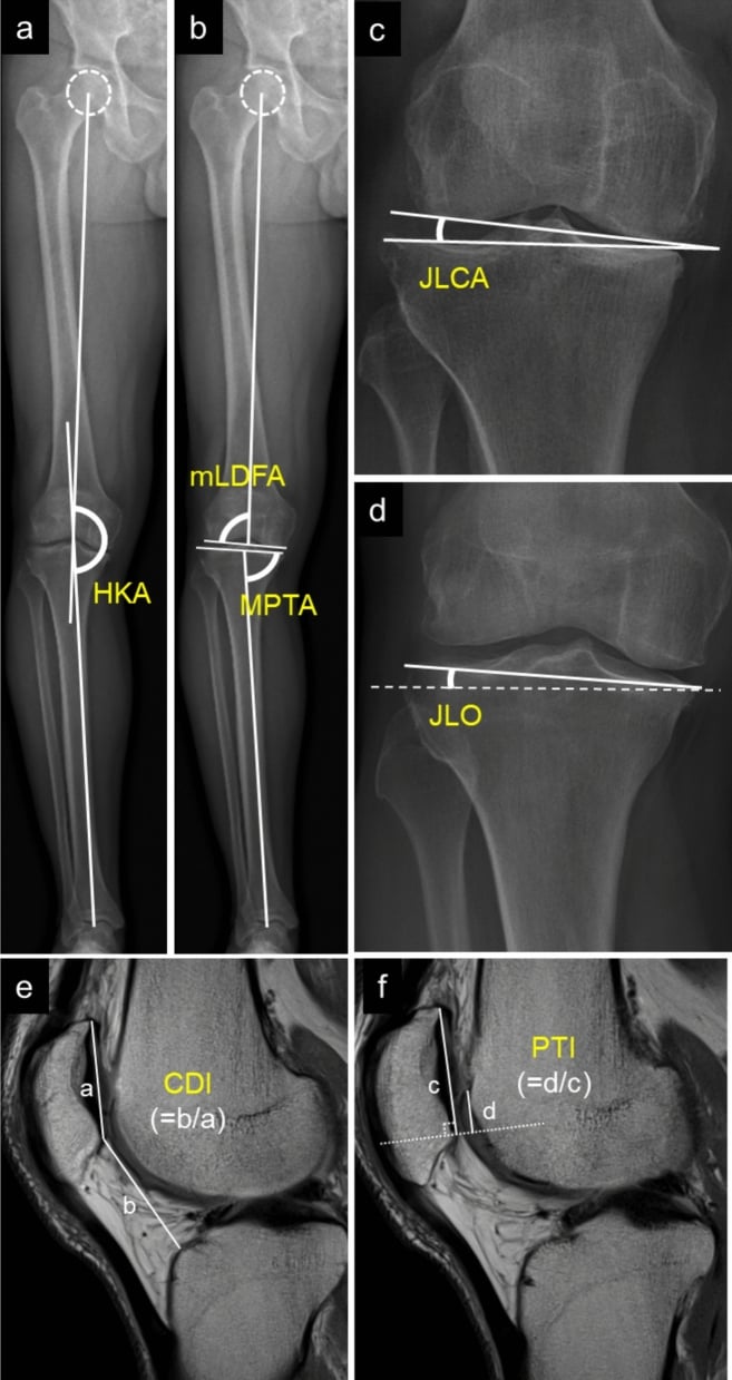 Standing long-leg EOS radiographs with alignment angles alongside sagittal MRI showing Caton-Deschamps and patellotrochlear indices