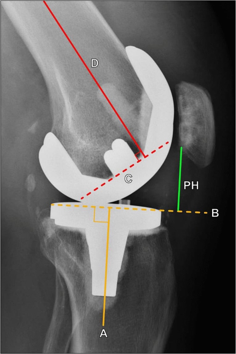 Lateral radiograph after total knee arthroplasty with patellar height measured against the tibial component articular surface and anatomic axis
