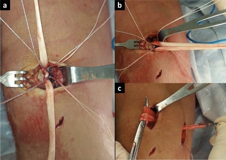 Intraoperative photographs showing exposure of the medial patellar border, placement of two suture anchors in the patella and preparation of a semitendinosus graft