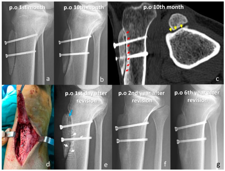 Serial radiographs after tibial tubercle osteotomy showing a persistent osteotomy line at ten months with CT confirmation and the appearance after revision