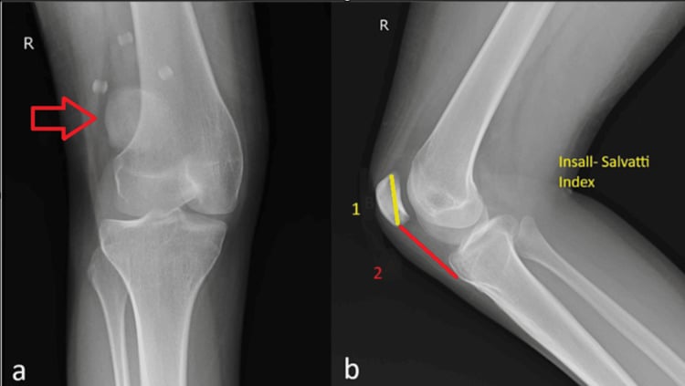 Anteroposterior radiograph showing the patella displaced laterally and a lateral view with an Insall-Salvati ratio greater than 1.5 indicating patella alta