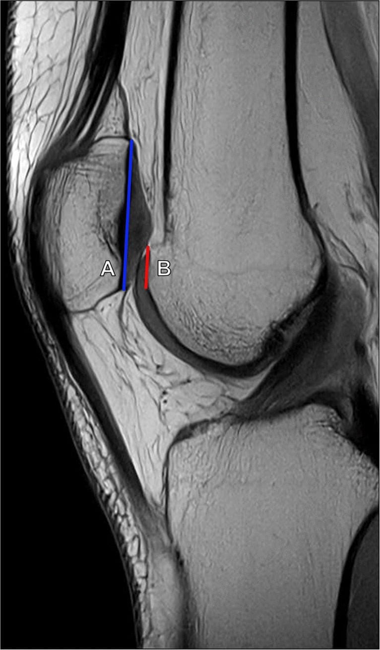 Sagittal MRI showing measurement of the patellotrochlear index on the midline section through the thickest patellar articular cartilage