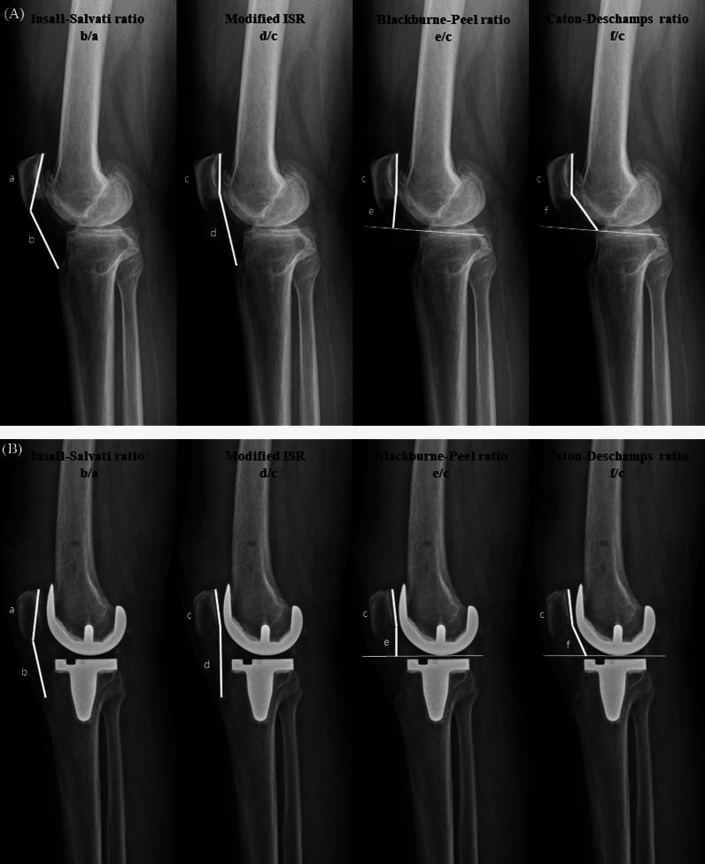 Pre-operative and post-operative lateral radiographs evaluating patellar height parameters at zero and thirty degrees of knee flexion