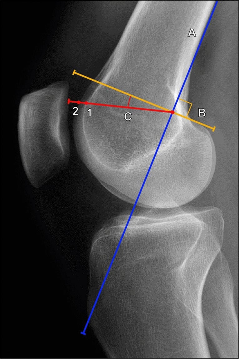 Lateral knee radiograph with trochlear depth measured by Dejour method using a line tangent to the posterior femoral cortex