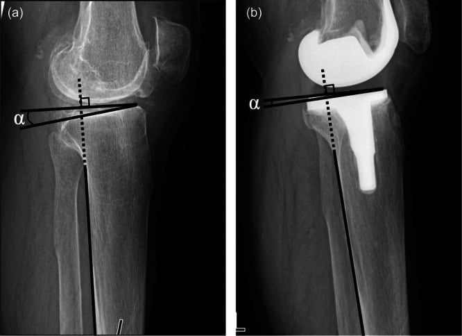 Pre-operative and post-operative lateral knee radiographs with sagittal alignment measurement lines